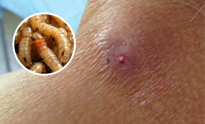 Confirman primer caso humano de gusano barrenador en Hidalgo